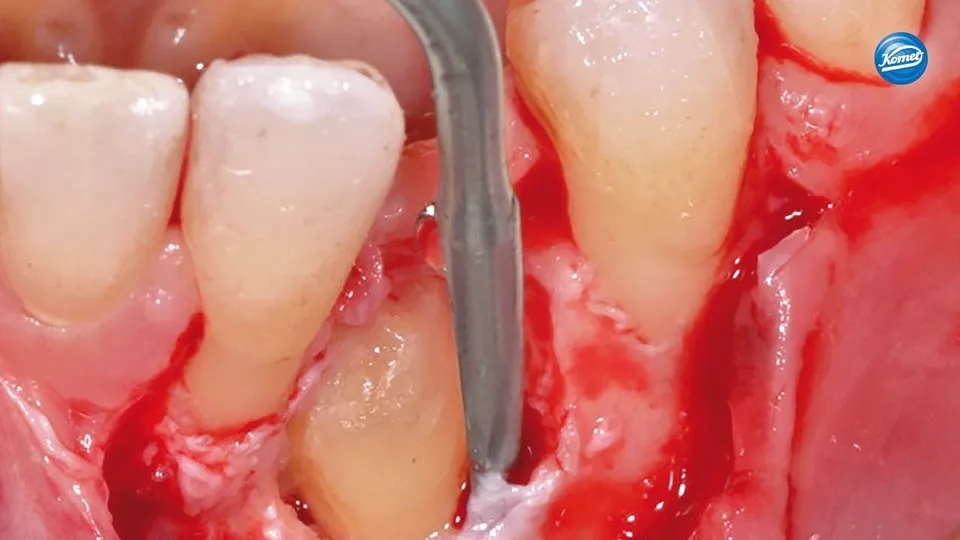 komet-dental-sonicline-video-schallinstrument-sfs90m-sfs90d image 1