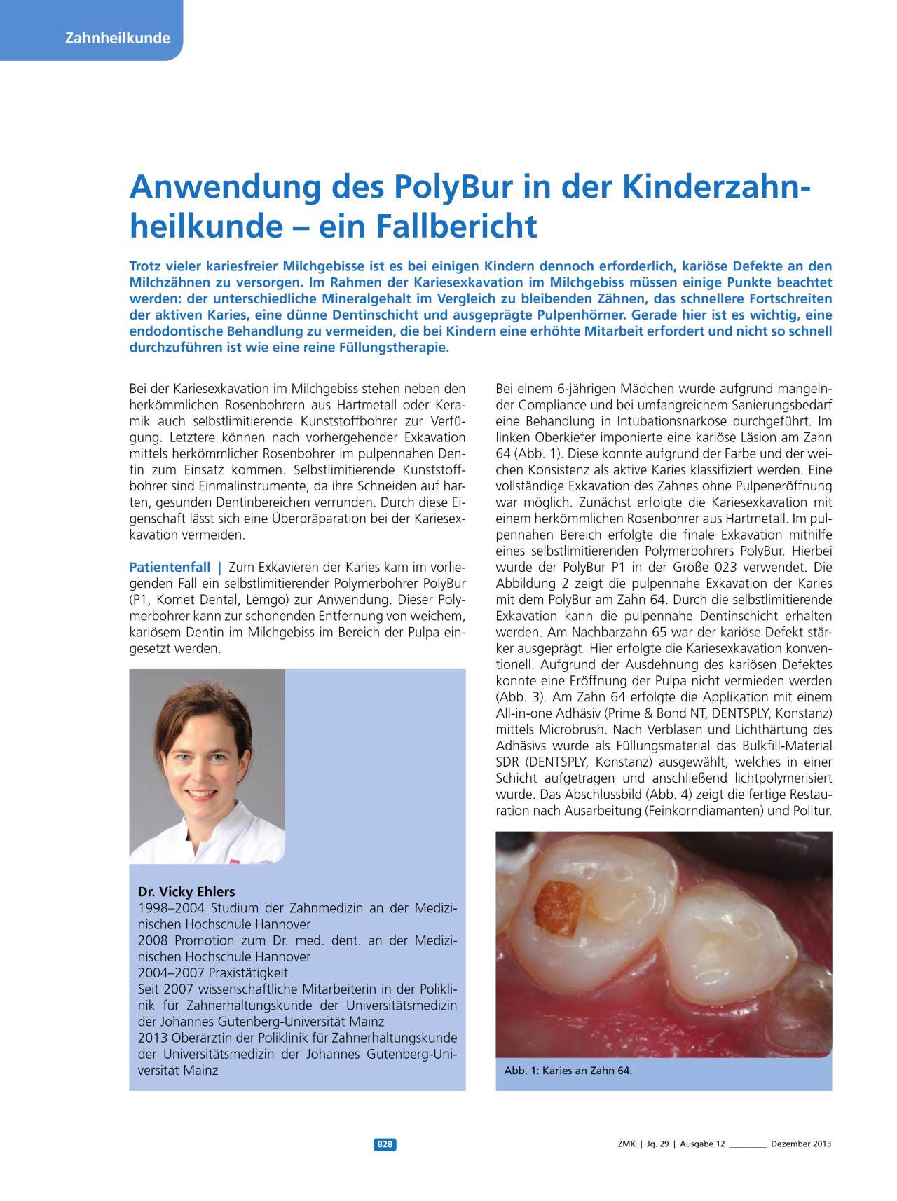 komet-dental-polybur-fachbericht-kinderzahnheilkunde image 1