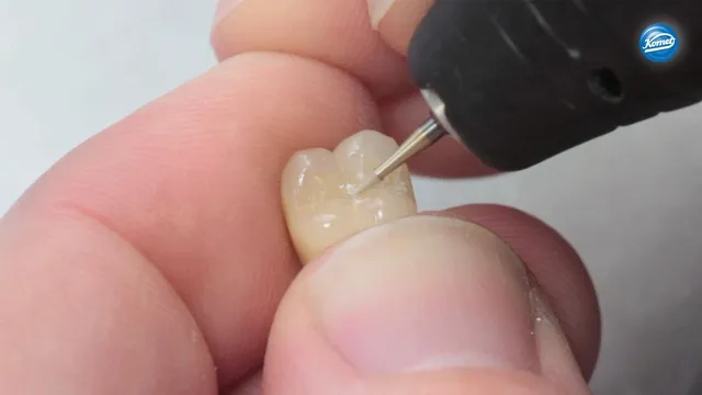 komet-dental-diao-video-okklusalfl-che-verblendkrone image 1