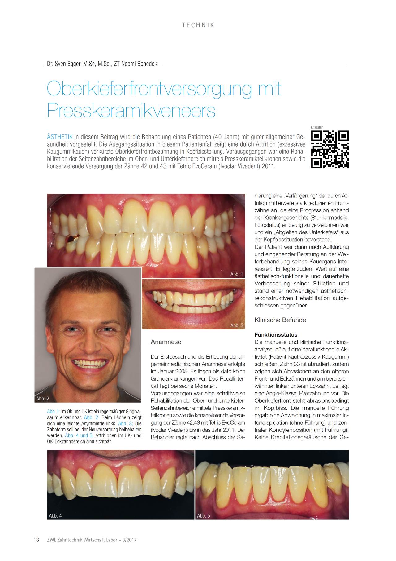 komet-dental-ceracut-fachbericht-presskeramik-veneers image 1