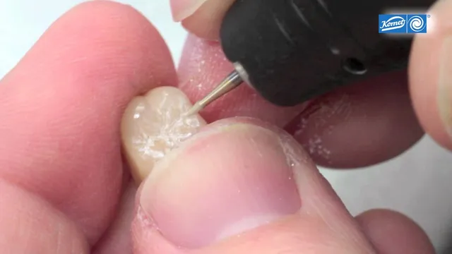 komet-dental-diao-video-okklusionsgestaltung-seitenzahnkrone image 1