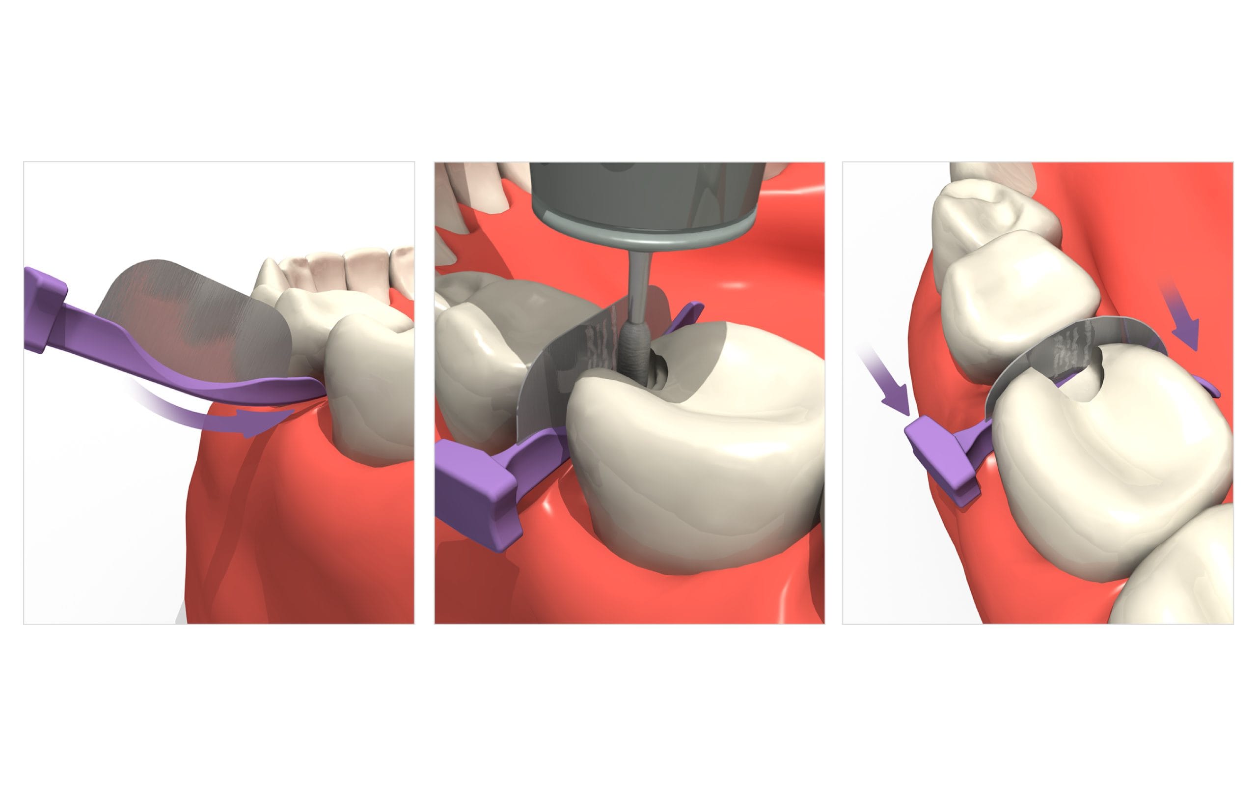 luxator-fendermate-temp-teilmatrize-keil-provisorisch image 6