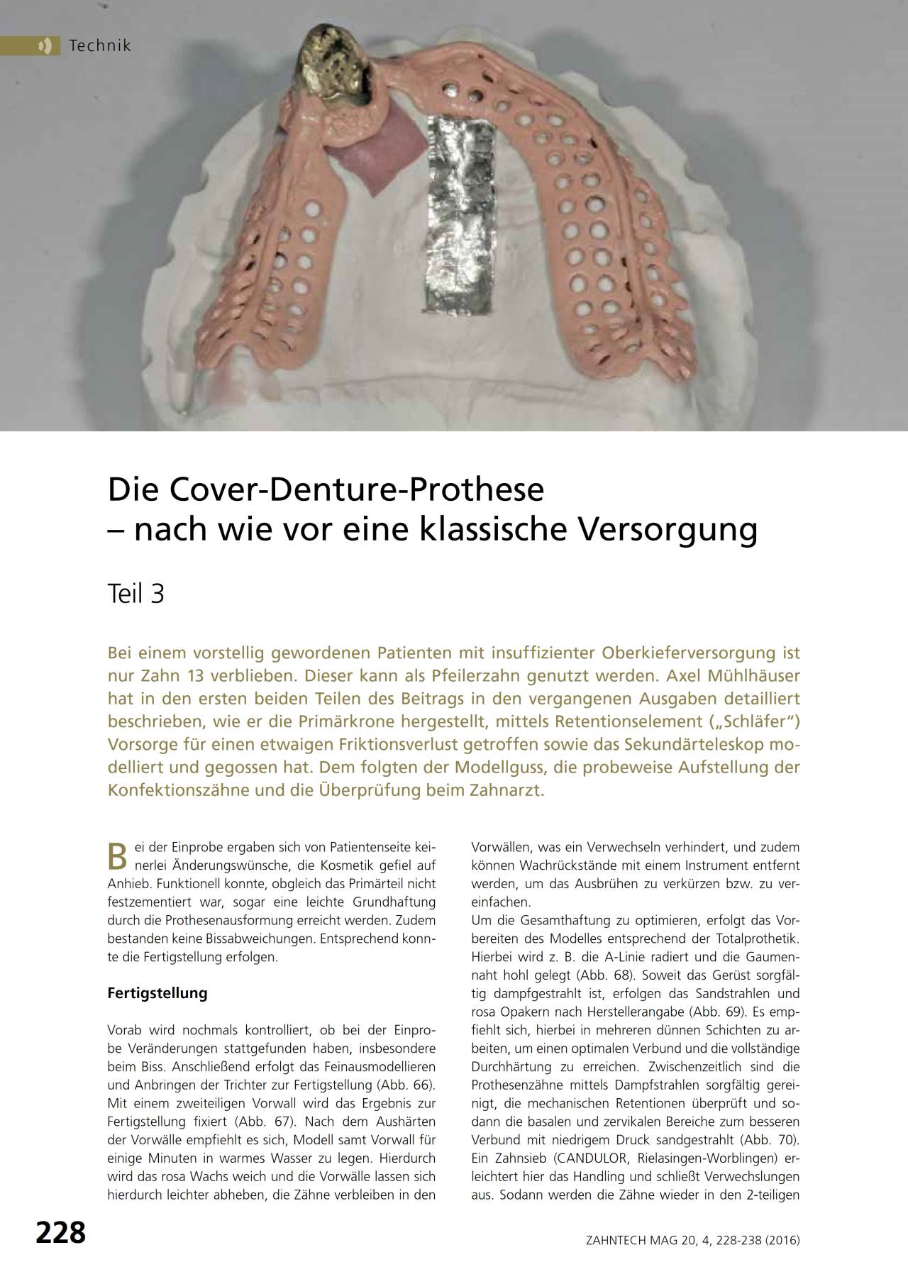 komet-shax-cover-denture-prothese-teil-3-fachbericht image 1