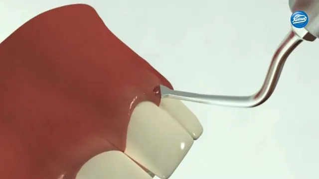 komet-diao-schallspitzen-video-kronenverl-ngerung image 1