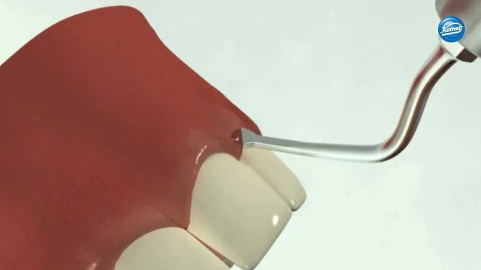 komet-diao-schallspitzen-video-kronenverl-ngerung image 1