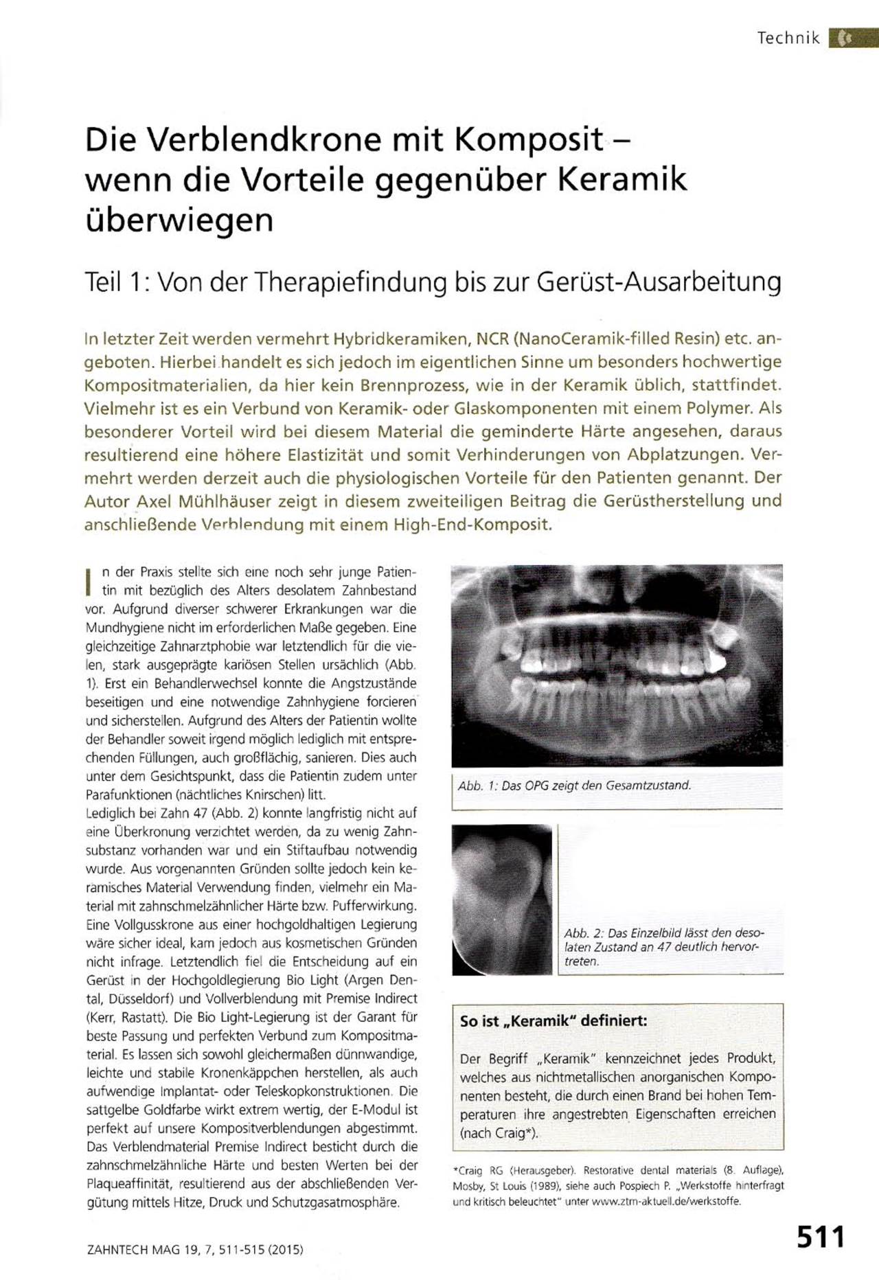 komet-dental-ceracut-fachbericht-verblendkrone-komposit image 1