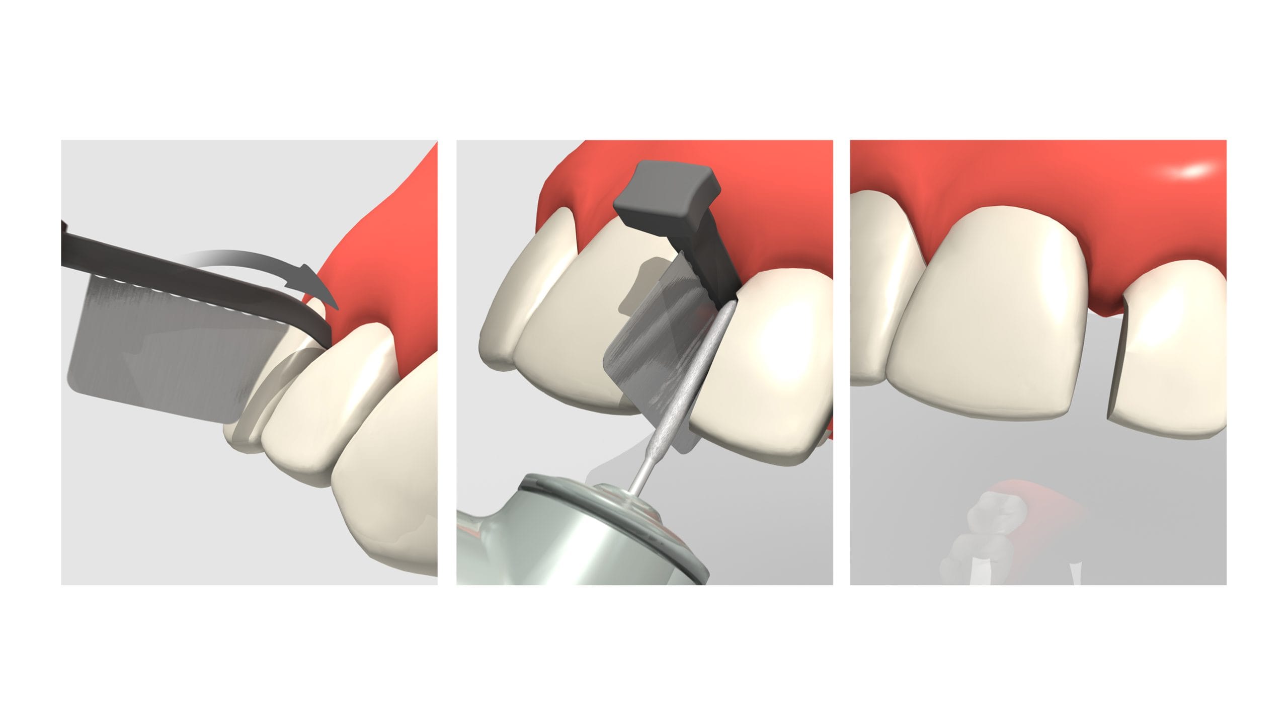 luxator-fenderwedge-prep-interdentalkeil-stahlplatte-krone image 4