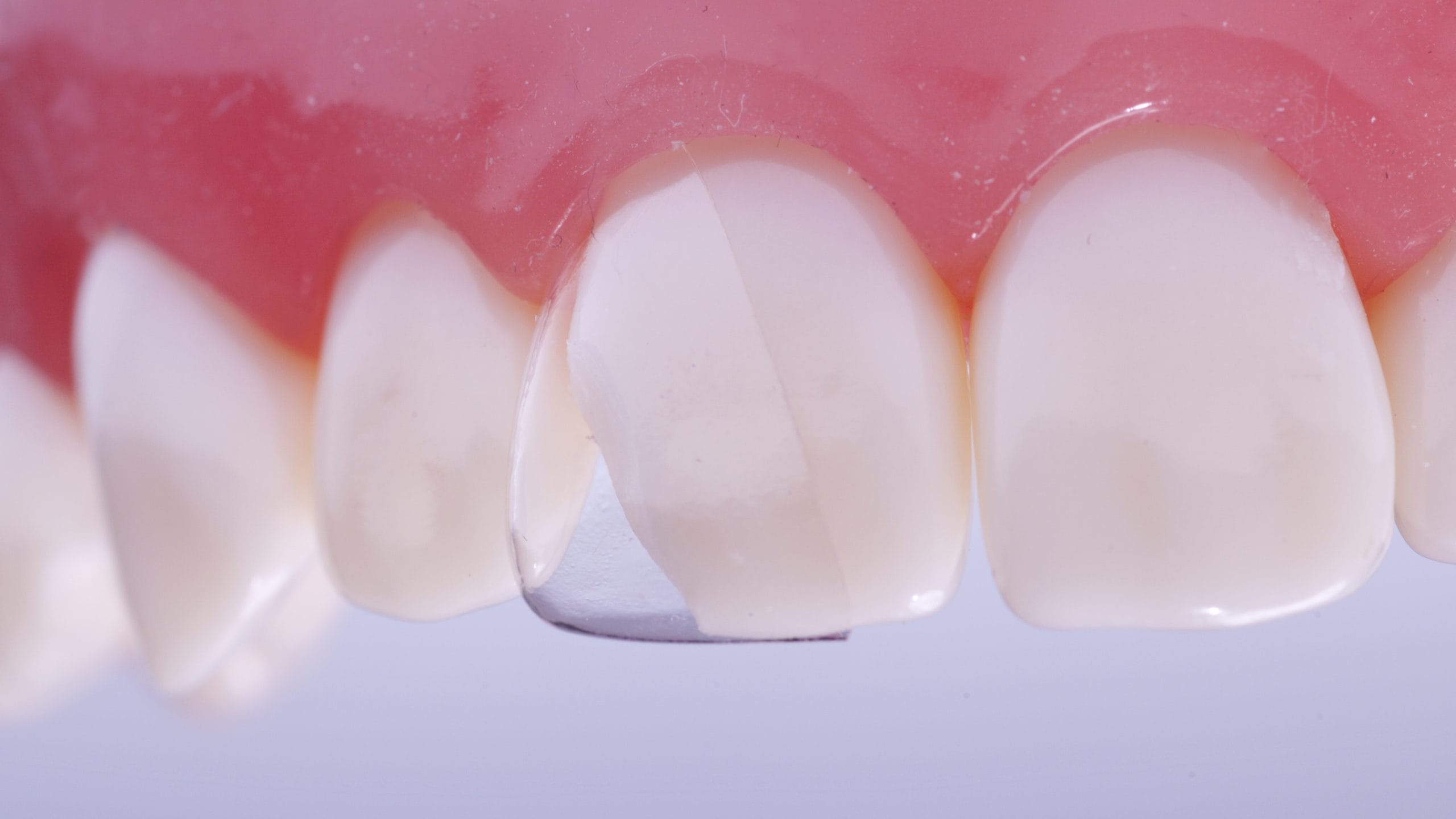 luxator-restorative-coform-matrize-komposit-klasse-iv-transparent image 2