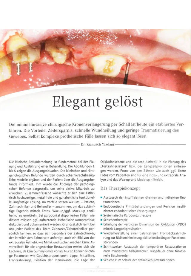 komet-dental-diao-fachbericht-elegant-gel-st-kronenverl-ngerung image 1