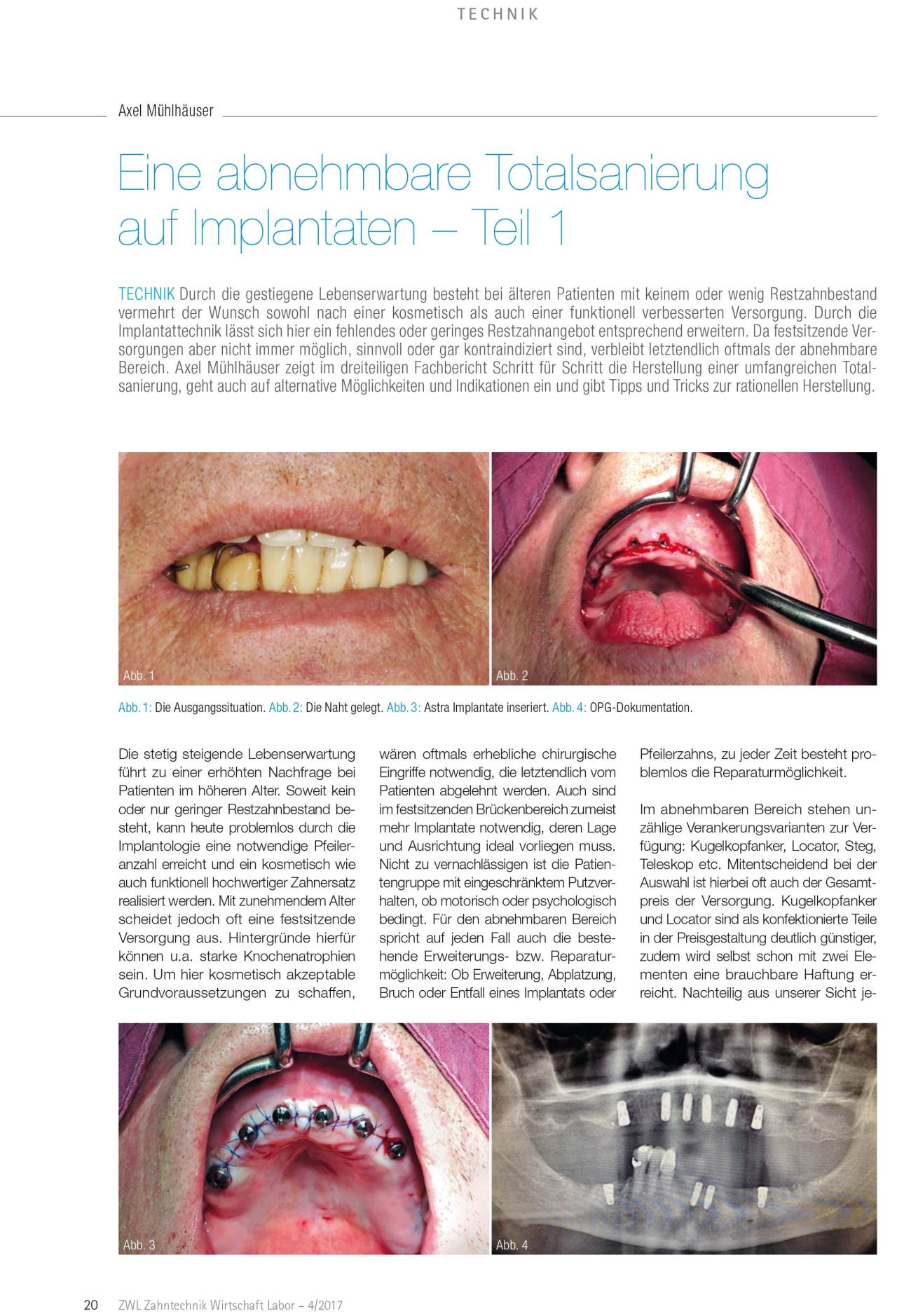 komet-ceradrill-totalsanierung-implantate-fachbericht-teil-1-3 image 1