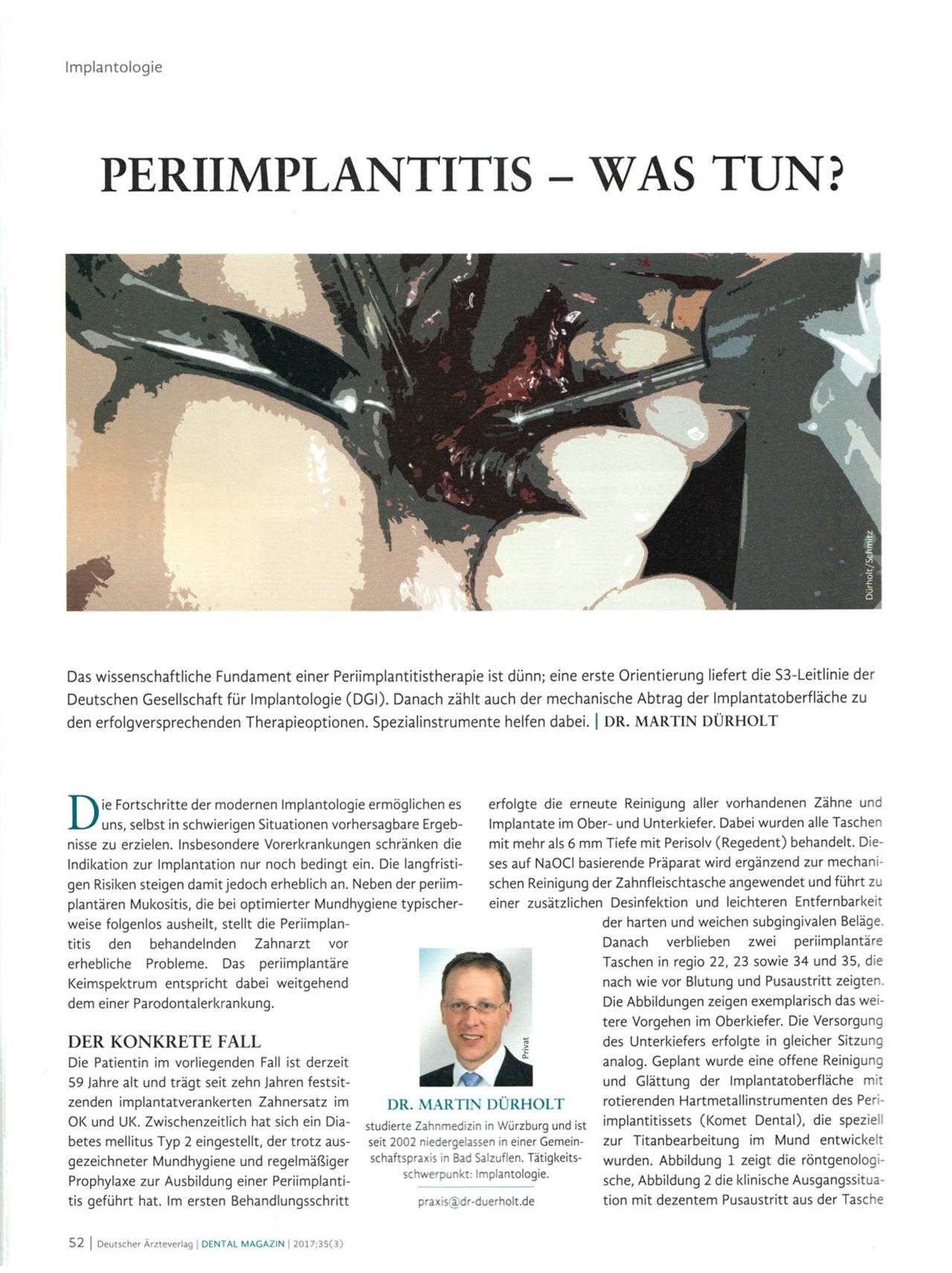 komet-ceradrill-periimplantitis-fachbericht-dgi-leitlinie image 1