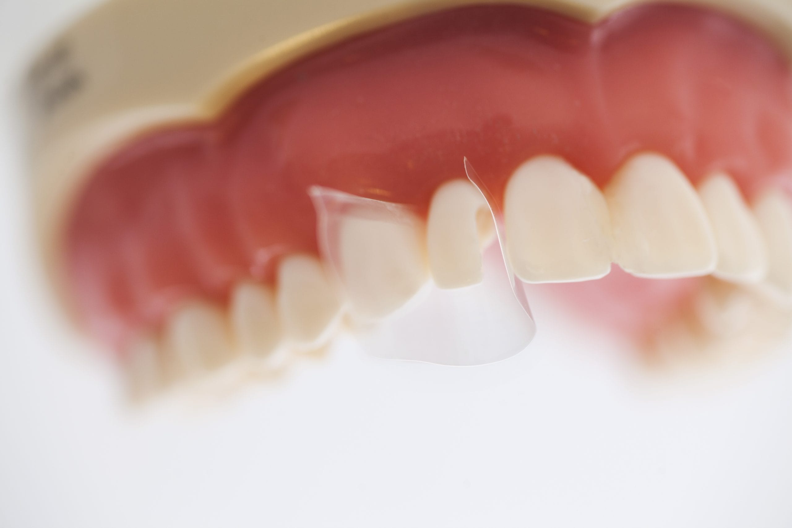 luxator-restorative-proxypal-matrizenband-frontzahn-diastema image 3