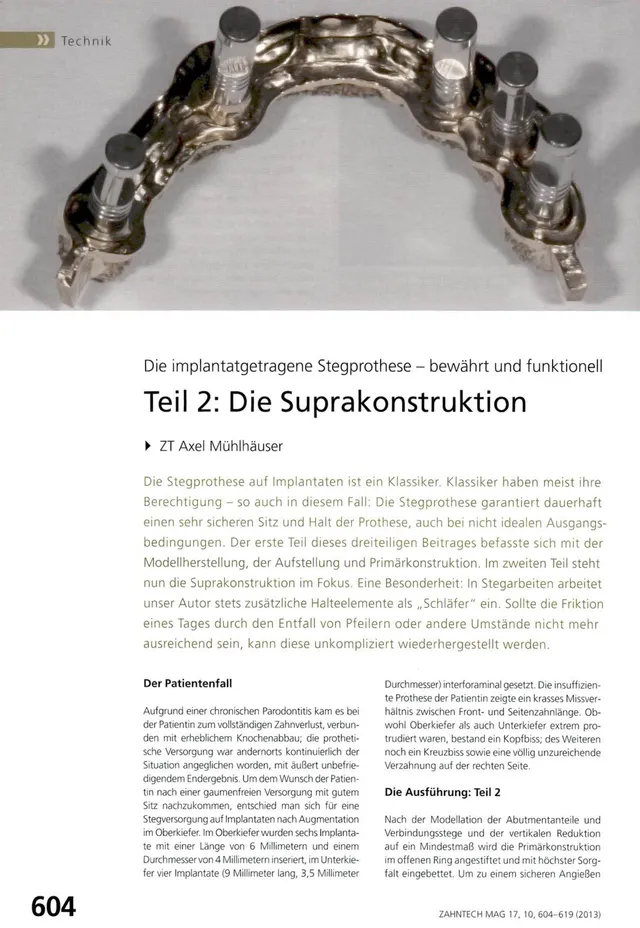 komet-dental-diao-fachbeitrag-suprakonstruktion-stegprothese image 1
