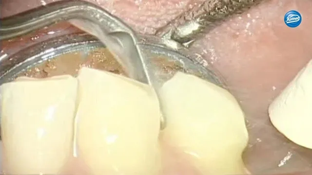 komet-sonicline-video-stumpfpr-paration-kronen-agabiti image 1