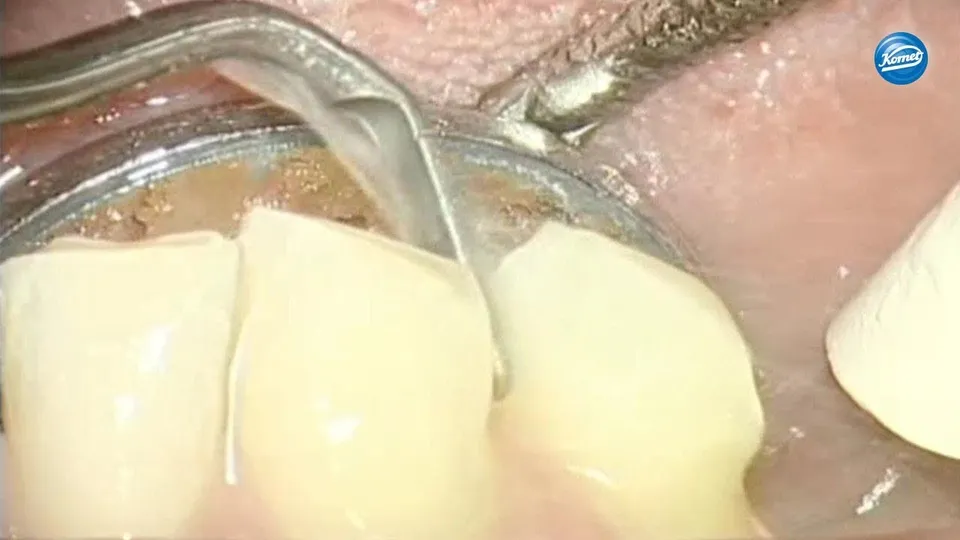 komet-sonicline-video-stumpfpr-paration-kronen-agabiti image 1