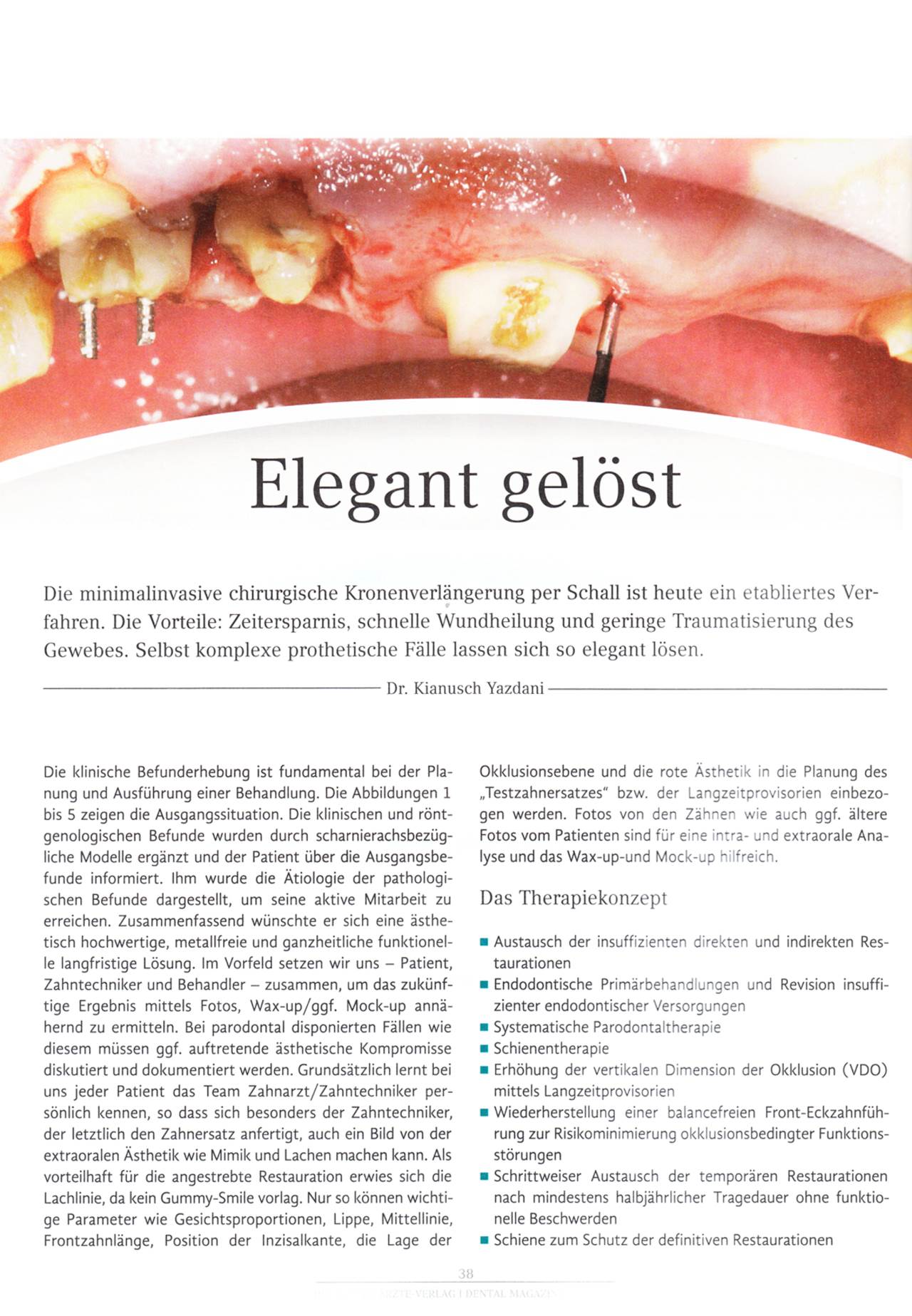 komet-dental-diao-fachbericht-elegant-gel-st-kronenverl-ngerung image 1