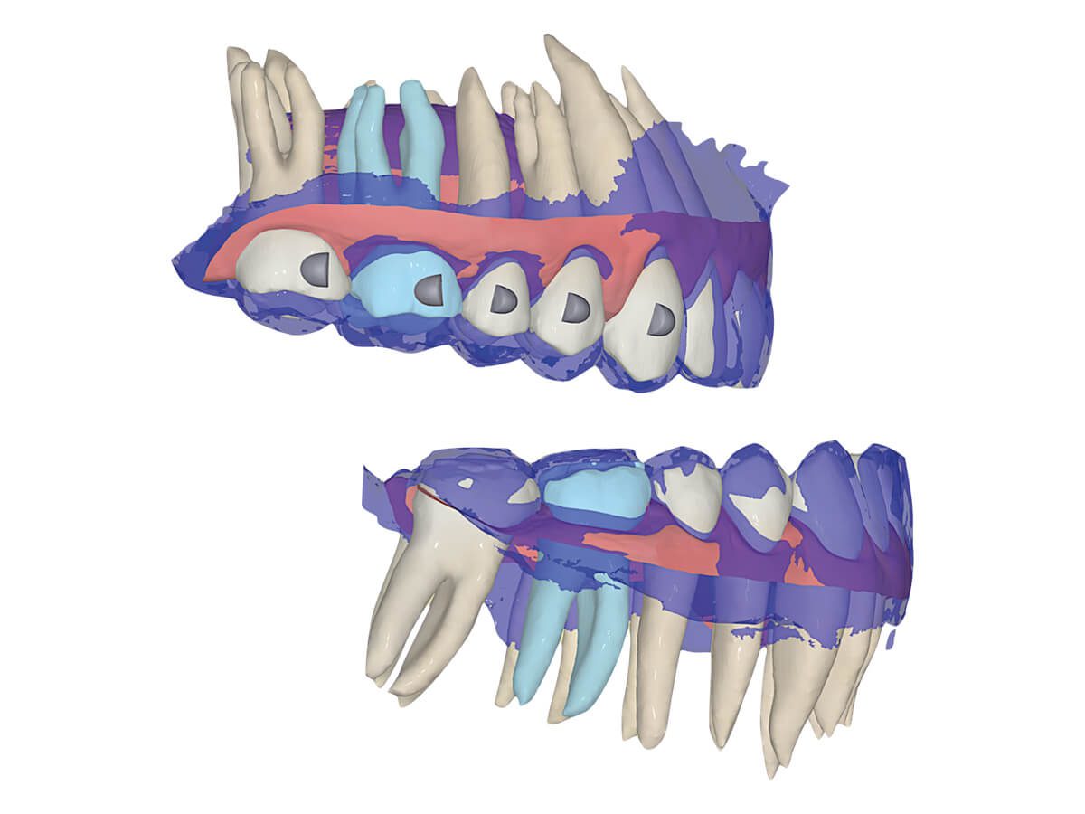 forestadent-fas-aligner-system-digitale-behandlungsplanung-wizard image 6