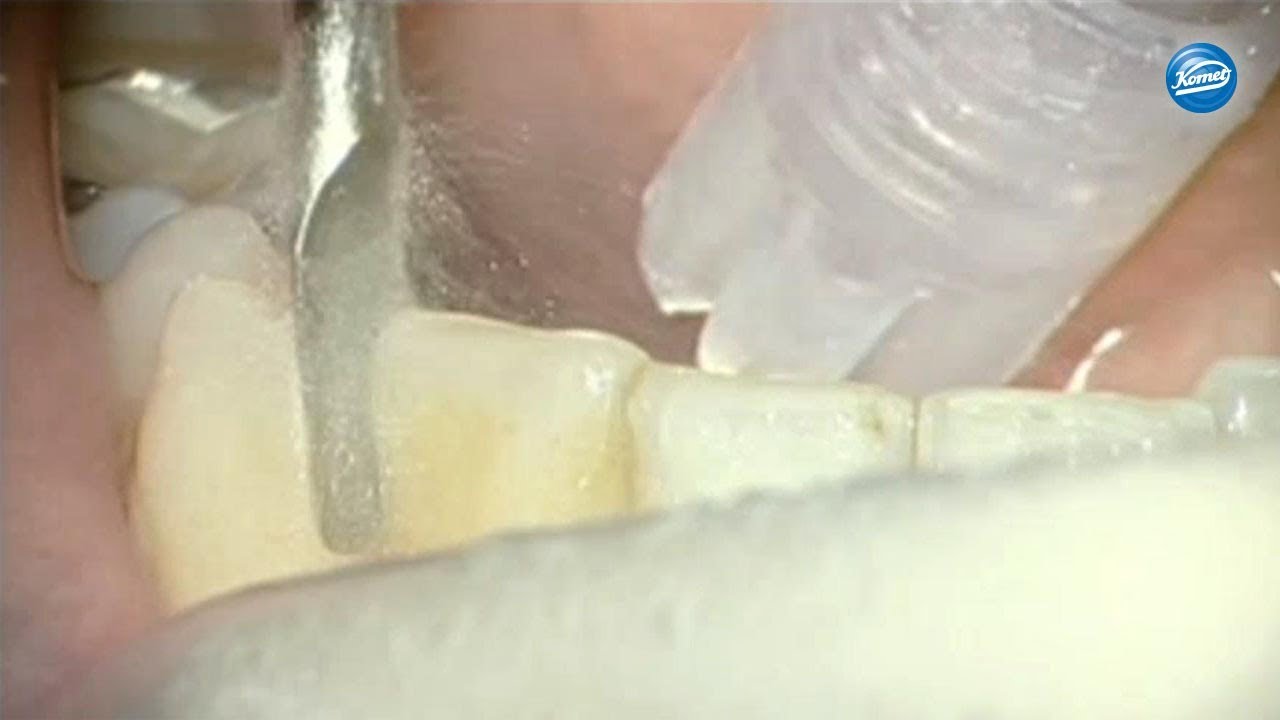 komet-sonicline-ipr-video-kieferorthop-dische-anwendung image 1