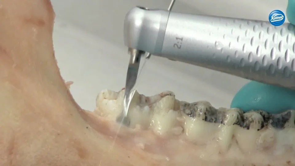 komet-fq-video-hubfeilen-diamantiert-parodontal image 1