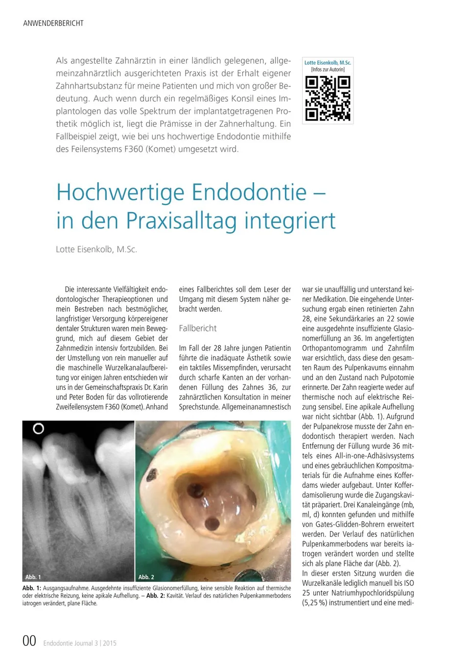 komet-fq-fachbericht-f360-endodontie-praxisalltag-feilensystem image 1