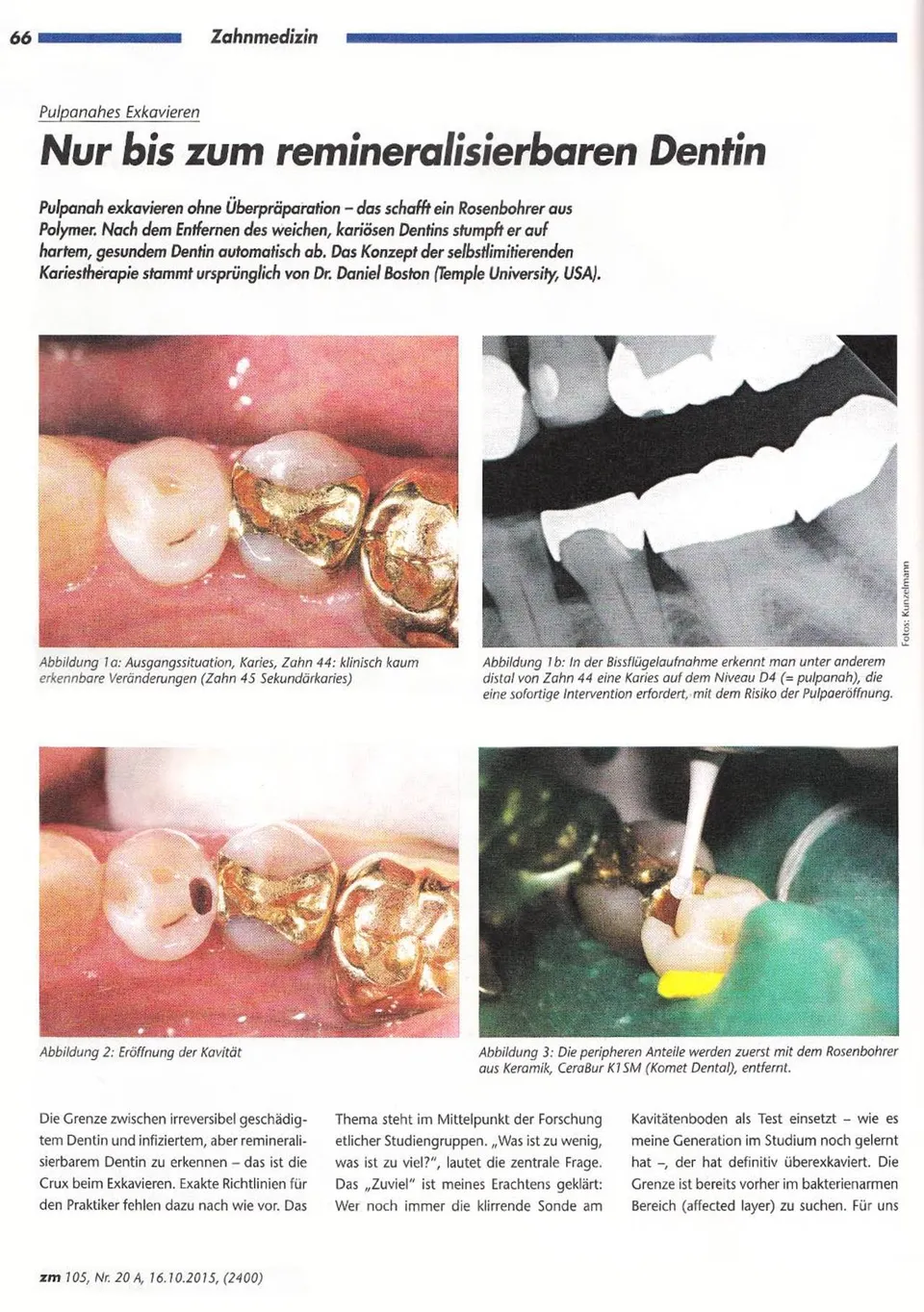 komet-diao-fachbericht-dentin-exkavieren image 1