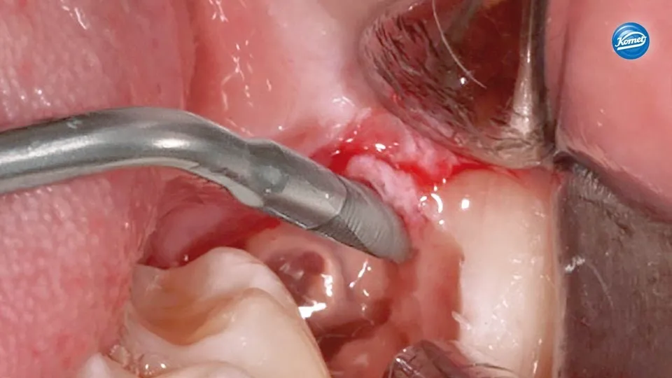 komet-ceradrill-video-eckzahn-extraktion-sfs90 image 1