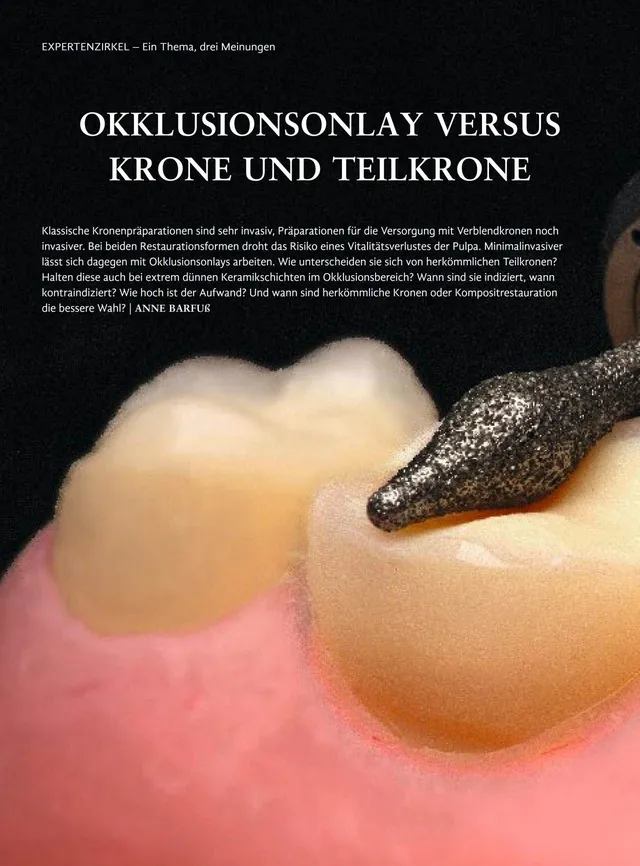 komet-diao-set-4665-okklusionsonlay-fr-ser-krone image 1