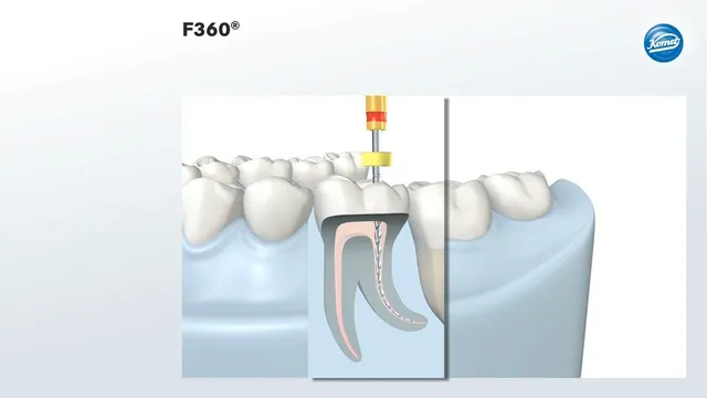 komet-dental-f360-niti-feilen-endo image 1